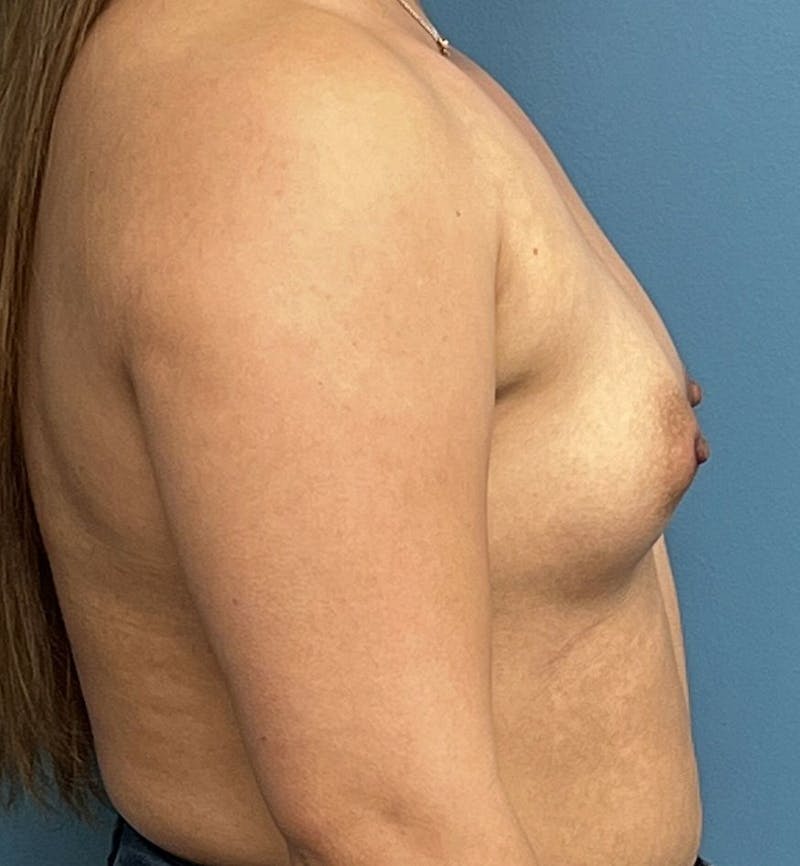 Breast Augmentation Before & After Gallery - Patient 189965 - Image 3