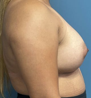 Breast Augmentation Before & After Gallery - Patient 189965 - Image 4