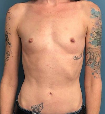 Breast Augmentation Before & After Gallery - Patient 244168 - Image 1