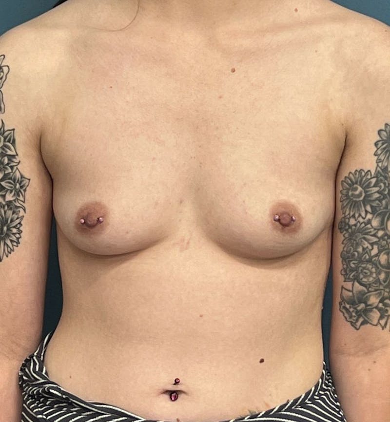 Breast Augmentation Before & After Gallery - Patient 229700 - Image 1