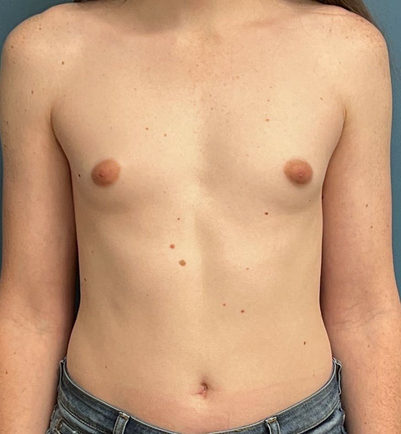 Breast Augmentation Before & After Gallery - Patient 254257 - Image 1