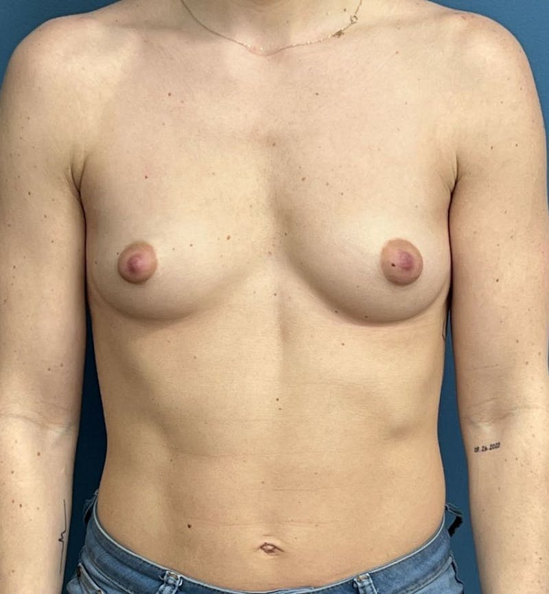 Breast Augmentation Before & After Gallery - Patient 119277 - Image 1