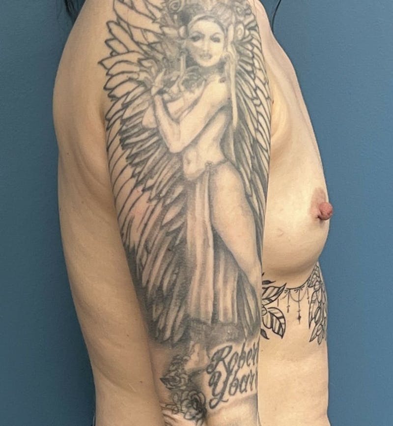 Breast Augmentation Before & After Gallery - Patient 228408 - Image 3