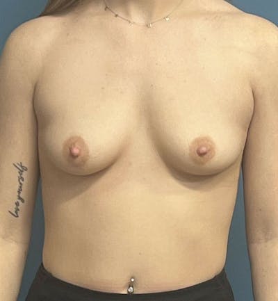 Breast Augmentation Before & After Gallery - Patient 584169 - Image 1