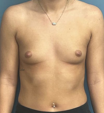 Breast Augmentation Before & After Gallery - Patient 436765 - Image 1