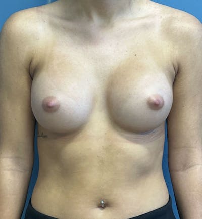 Breast Augmentation Before & After Gallery - Patient 436765 - Image 2
