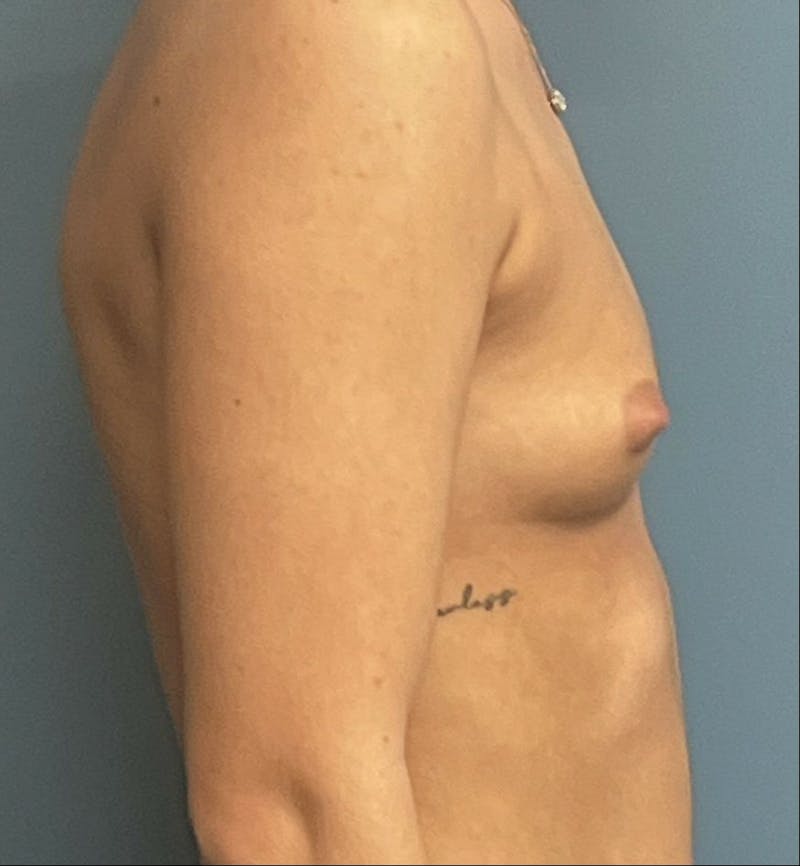 Breast Augmentation Before & After Gallery - Patient 436765 - Image 3