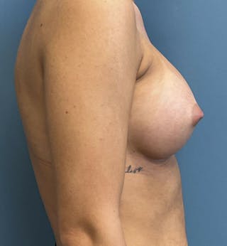 Breast Augmentation Before & After Gallery - Patient 436765 - Image 4
