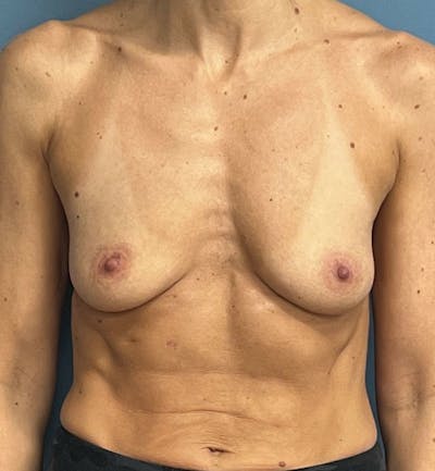 Breast Augmentation Before & After Gallery - Patient 833847 - Image 1