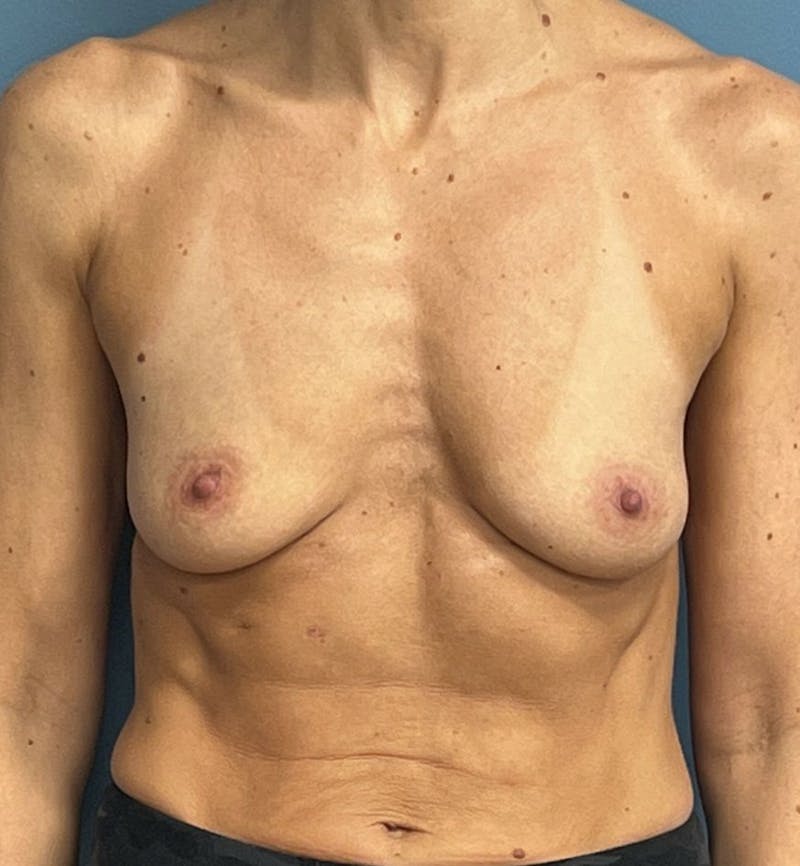 Breast Augmentation Before & After Gallery - Patient 833847 - Image 1