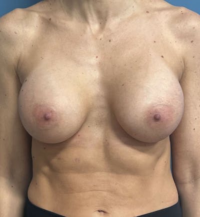 Breast Augmentation Before & After Gallery - Patient 833847 - Image 2