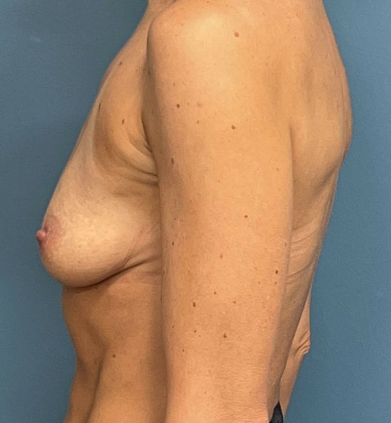 Breast Augmentation Before & After Gallery - Patient 833847 - Image 3