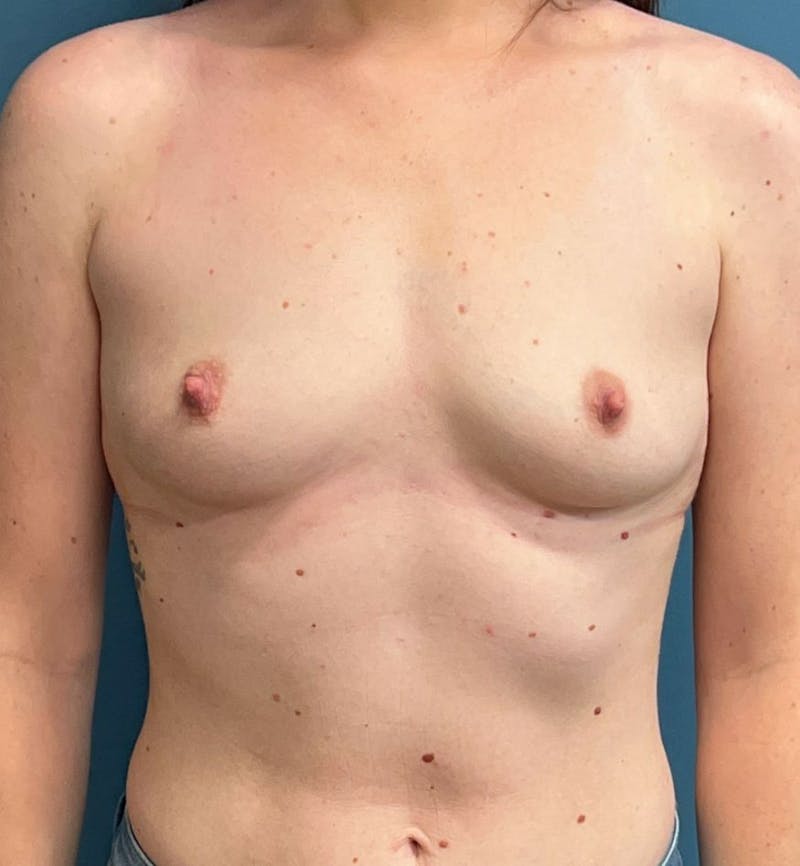 Breast Augmentation Before & After Gallery - Patient 121101 - Image 1