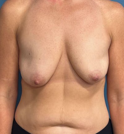 Breast Augmentation with Lift Before & After Gallery - Patient 490228 - Image 1