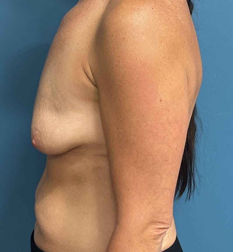 Breast Augmentation with Lift Before & After Gallery - Patient 490228 - Image 3
