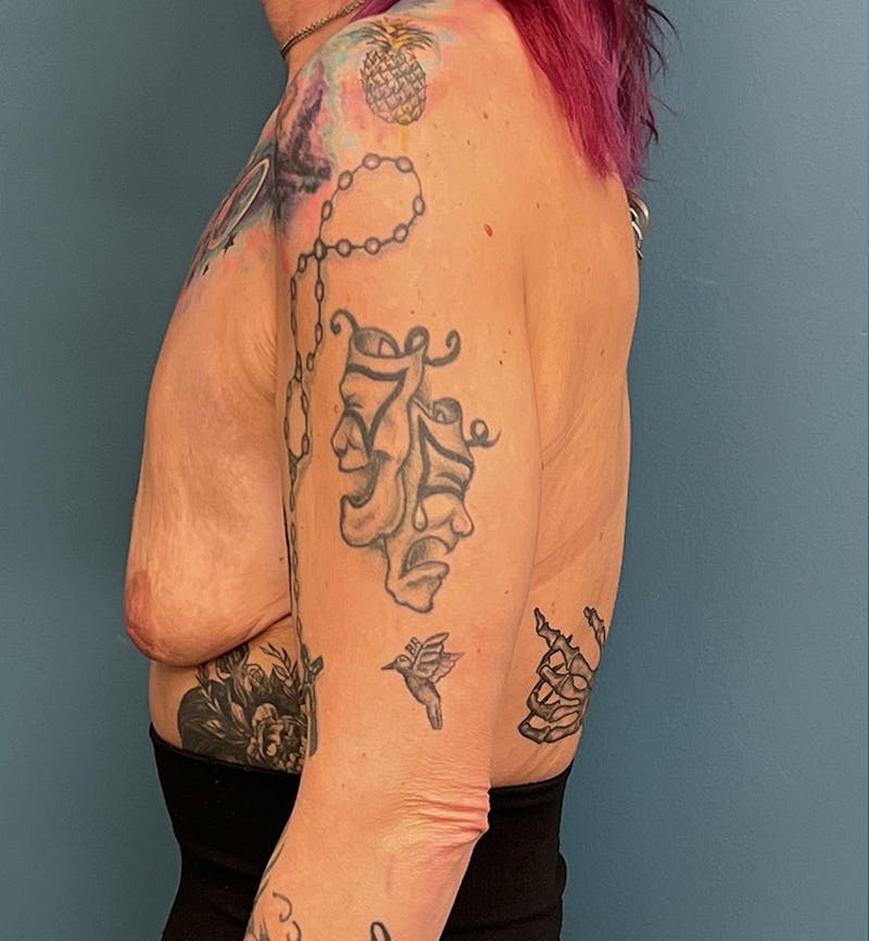 Breast Augmentation with Lift Before & After Gallery - Patient 386912 - Image 3