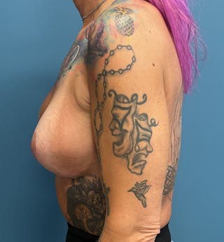 Breast Augmentation with Lift Before & After Gallery - Patient 386912 - Image 4