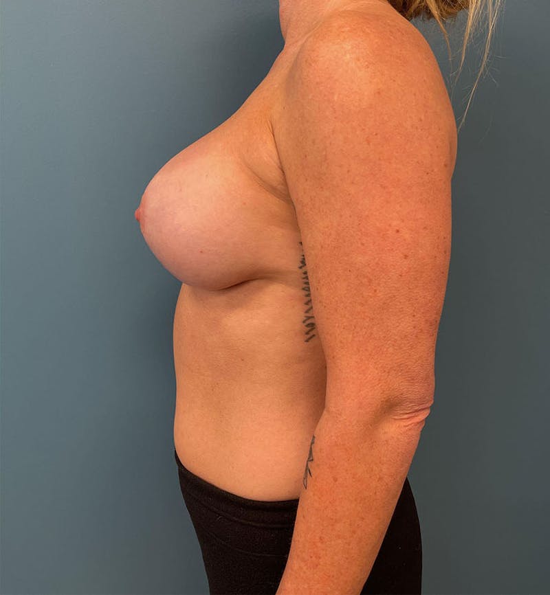 Breast Augmentation with Lift Before & After Gallery - Patient 427264 - Image 4