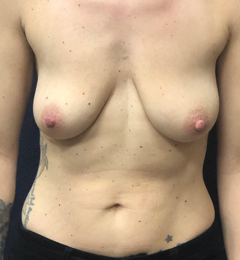 Breast Augmentation with Lift Before & After Gallery - Patient 272175 - Image 1