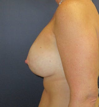 Breast Augmentation with Lift Before & After Gallery - Patient 131070 - Image 4
