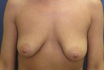Breast Augmentation with Lift Before & After Gallery - Patient 368819 - Image 1