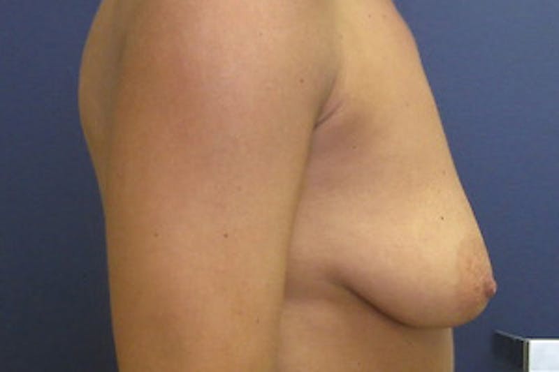 Breast Augmentation with Lift Before & After Gallery - Patient 368819 - Image 3