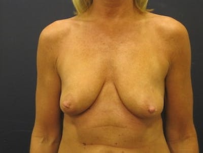 Breast Augmentation with Lift Before & After Gallery - Patient 434133 - Image 1