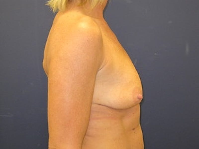 Breast Augmentation with Lift Before & After Gallery - Patient 434133 - Image 3