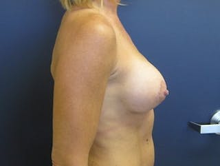 Breast Augmentation with Lift Before & After Gallery - Patient 434133 - Image 4