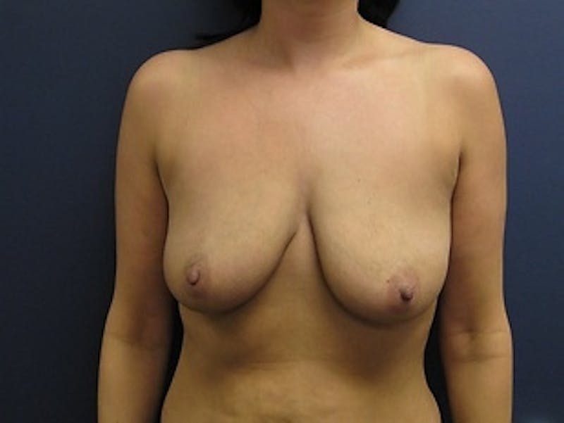 Breast Augmentation with Lift Before & After Gallery - Patient 423797 - Image 1