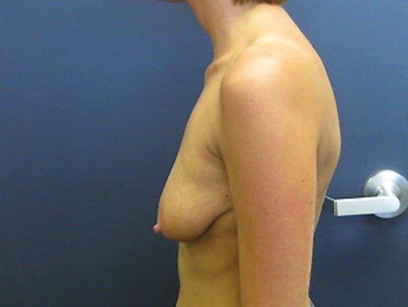 Breast Augmentation with Lift Before & After Gallery - Patient 676635 - Image 3