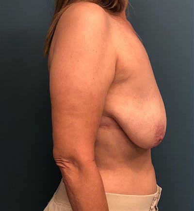Breast Augmentation with Lift Before & After Gallery - Patient 392802 - Image 1