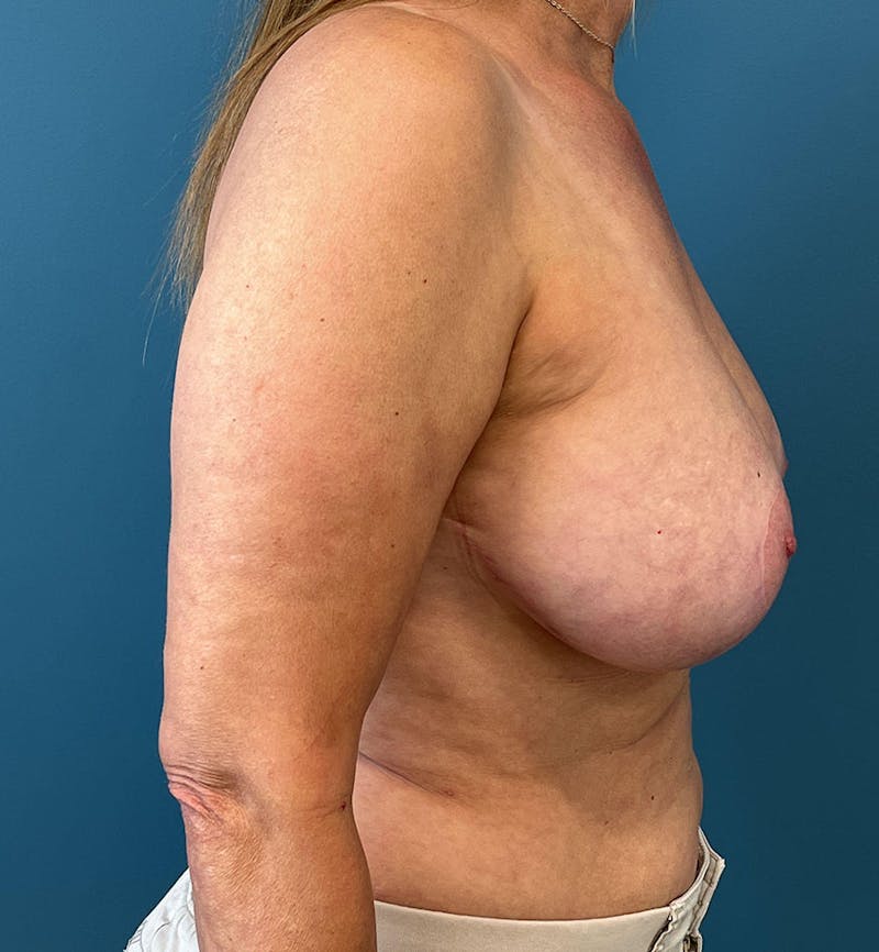 Breast Augmentation with Lift Before & After Gallery - Patient 392802 - Image 2