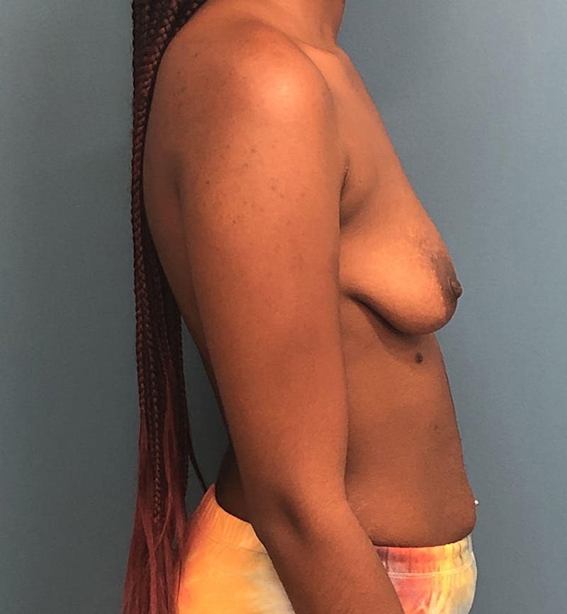 Breast Augmentation with Lift Before & After Gallery - Patient 365232 - Image 3