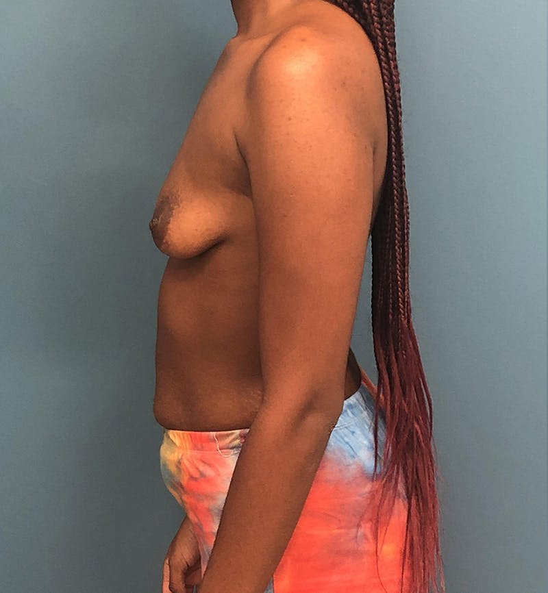 Breast Augmentation with Lift Before & After Gallery - Patient 365232 - Image 5