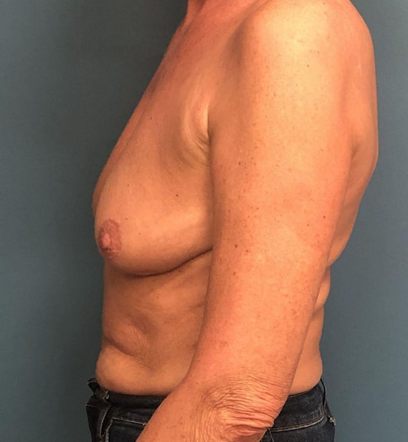 Breast Augmentation with Lift Before & After Gallery - Patient 425089 - Image 3