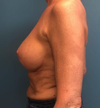 Breast Augmentation with Lift Before & After Gallery - Patient 425089 - Image 4
