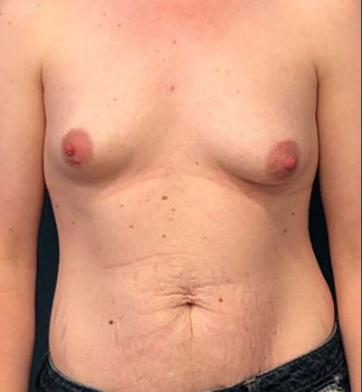 Breast Augmentation with Lift Before & After Gallery - Patient 395982 - Image 1