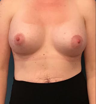 Breast Augmentation with Lift Before & After Gallery - Patient 395982 - Image 2
