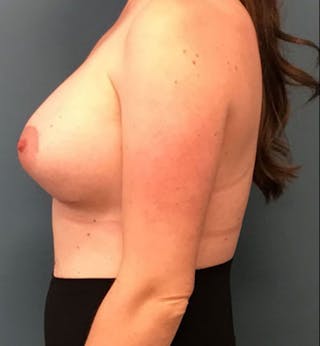 Breast Augmentation with Lift Before & After Gallery - Patient 395982 - Image 4