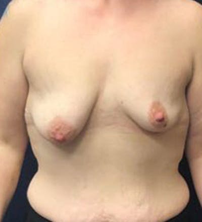 Breast Augmentation with Lift Before & After Gallery - Patient 250669 - Image 1