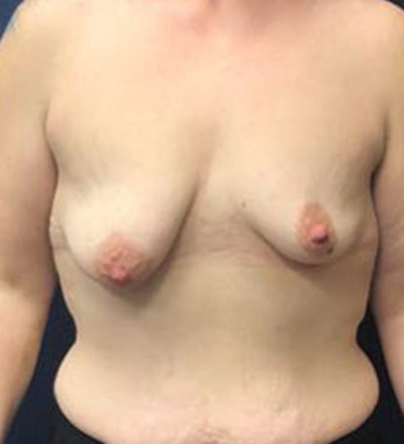 Breast Augmentation with Lift Before & After Gallery - Patient 250669 - Image 1