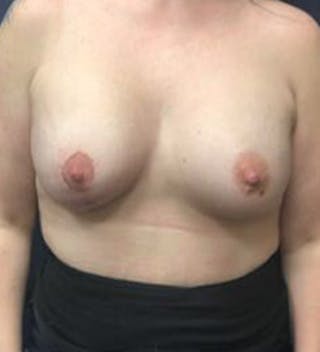 Breast Augmentation with Lift Before & After Gallery - Patient 250669 - Image 2