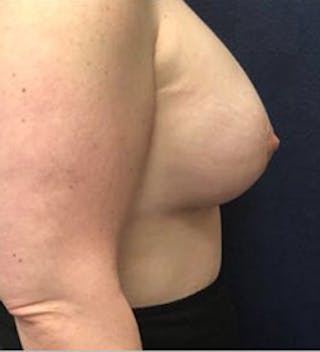 Breast Augmentation with Lift Before & After Gallery - Patient 250669 - Image 4