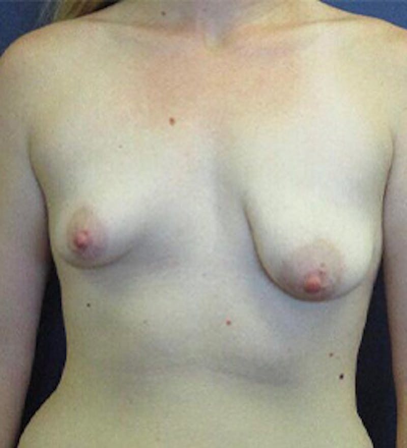 Breast Augmentation with Lift Before & After Gallery - Patient 415780 - Image 1