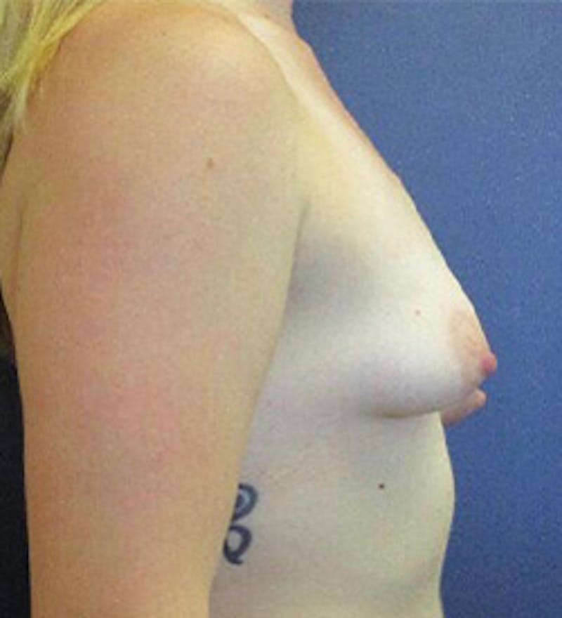 Breast Augmentation with Lift Before & After Gallery - Patient 415780 - Image 3