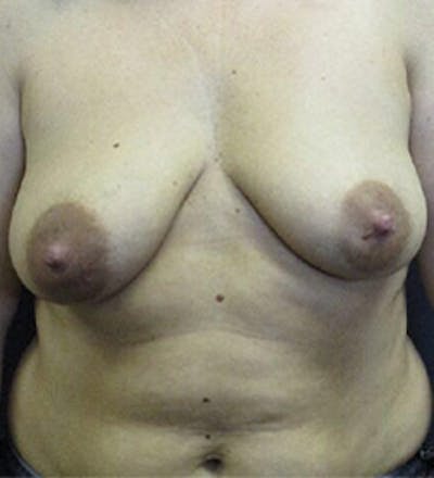 Breast Augmentation with Lift Before & After Gallery - Patient 253931 - Image 1