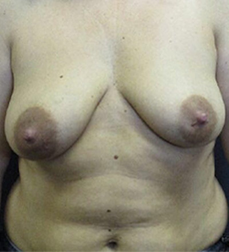 Breast Augmentation with Lift Before & After Gallery - Patient 253931 - Image 1