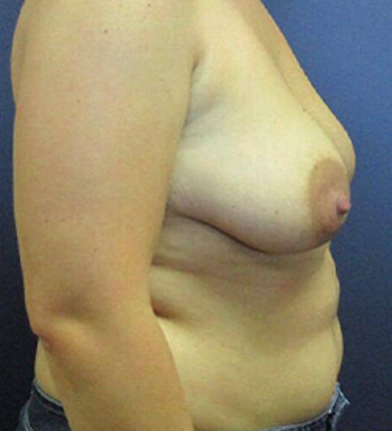 Breast Augmentation with Lift Before & After Gallery - Patient 253931 - Image 5