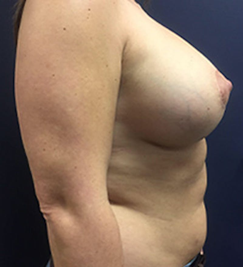 Breast Augmentation with Lift Before & After Gallery - Patient 253931 - Image 6